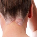 psoriasis-neck